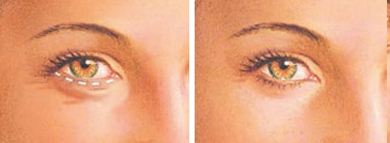 eyelid-surgery-lower-eyelid-incision (2)-min