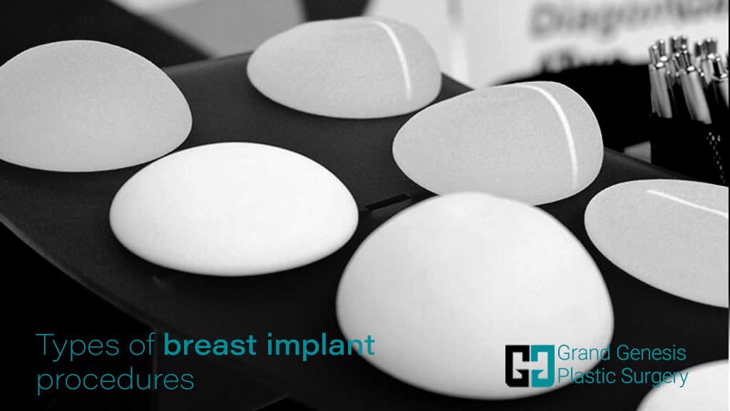 breast prosthesis types