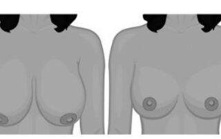 6-What-is-breast-reduction-surgery-or-reduction-mammoplasty-min