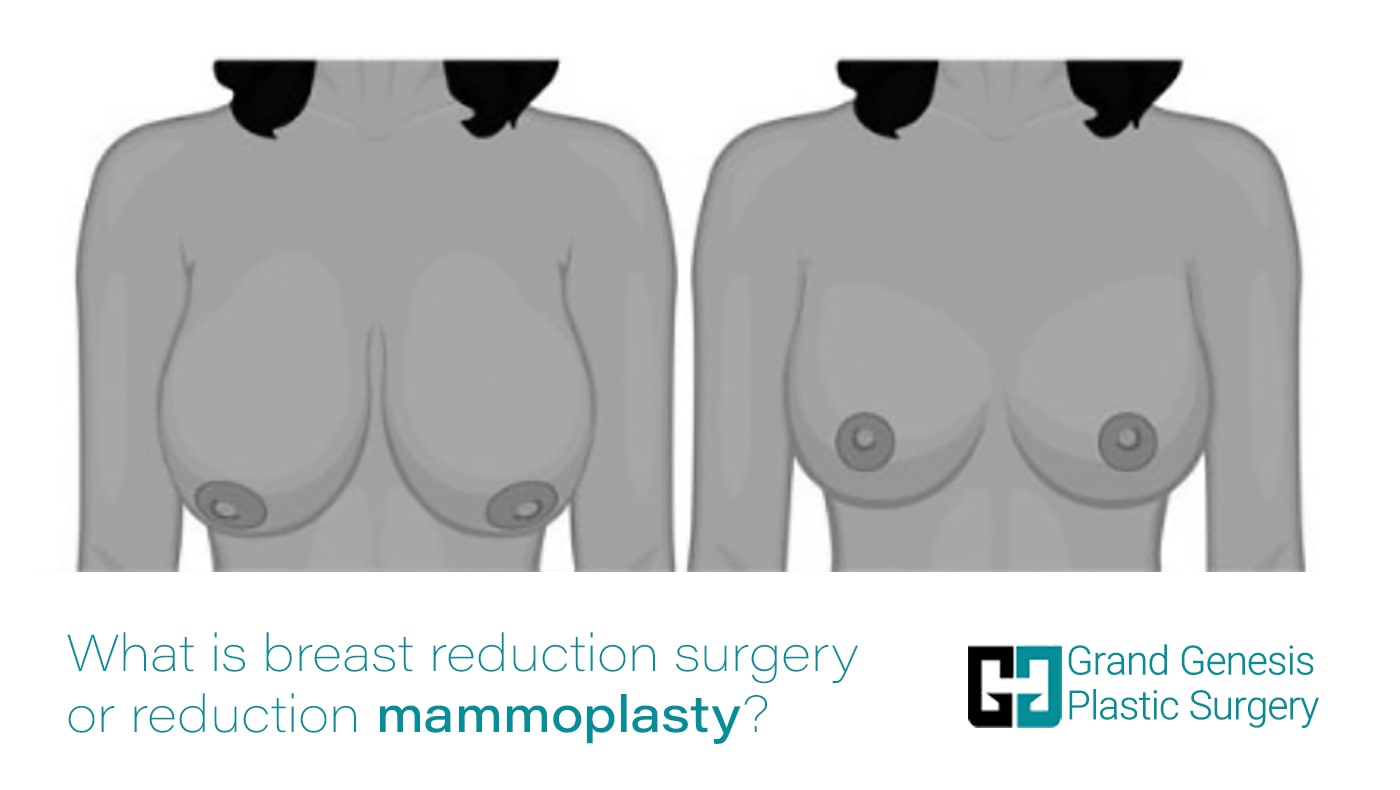 6-What-is-breast-reduction-surgery-or-reduction-mammoplasty-min