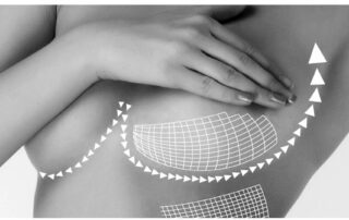 7-What-is-Breast-lift-What-are-the-non-surgical-breast-lift-methods-min