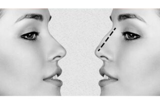 What is rhinoplasty
