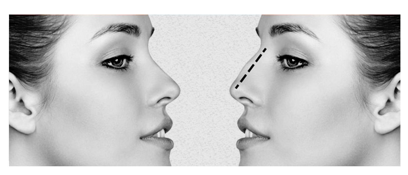 What is rhinoplasty