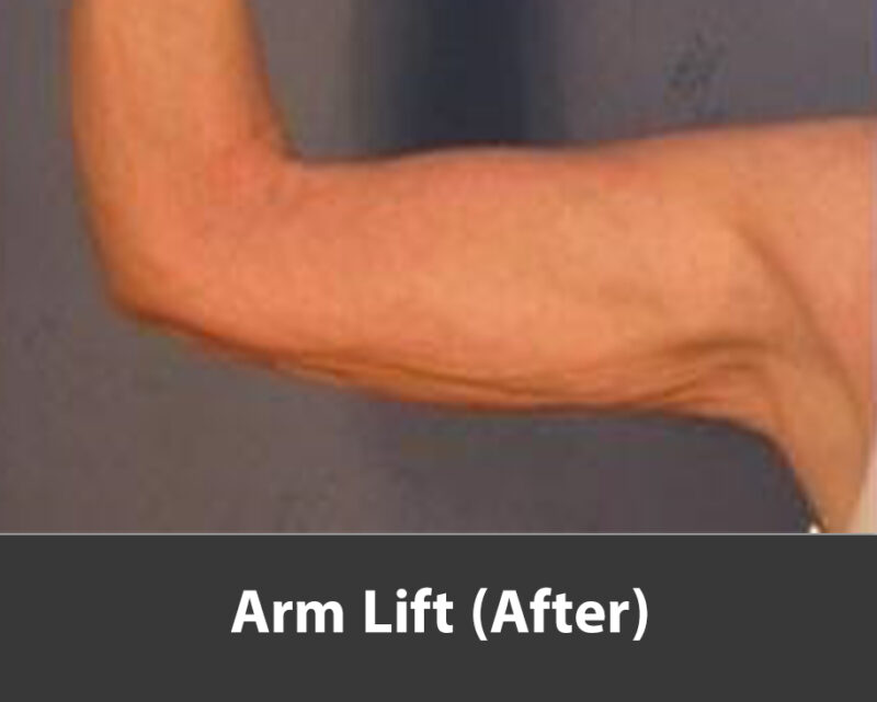 arm lift after