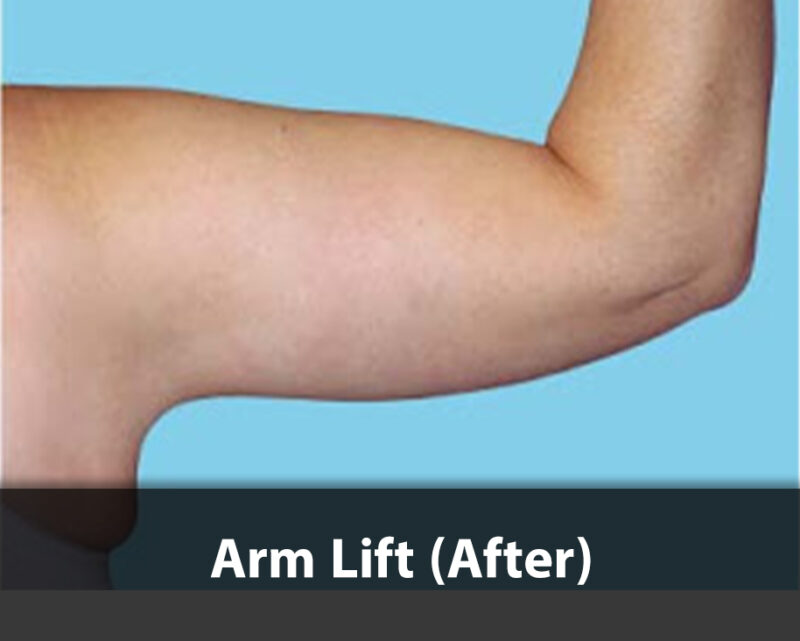 arm lift after