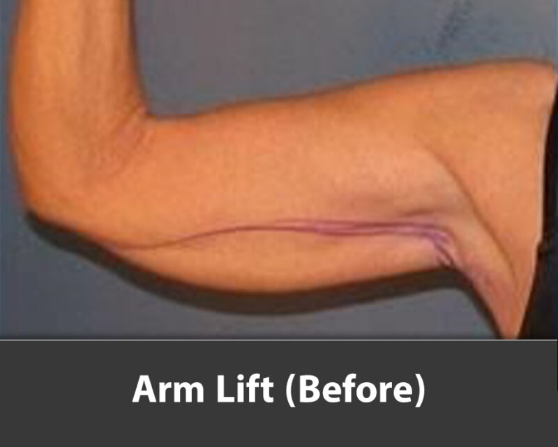 arm lift before