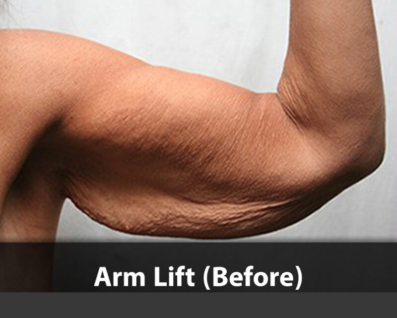arm lift before