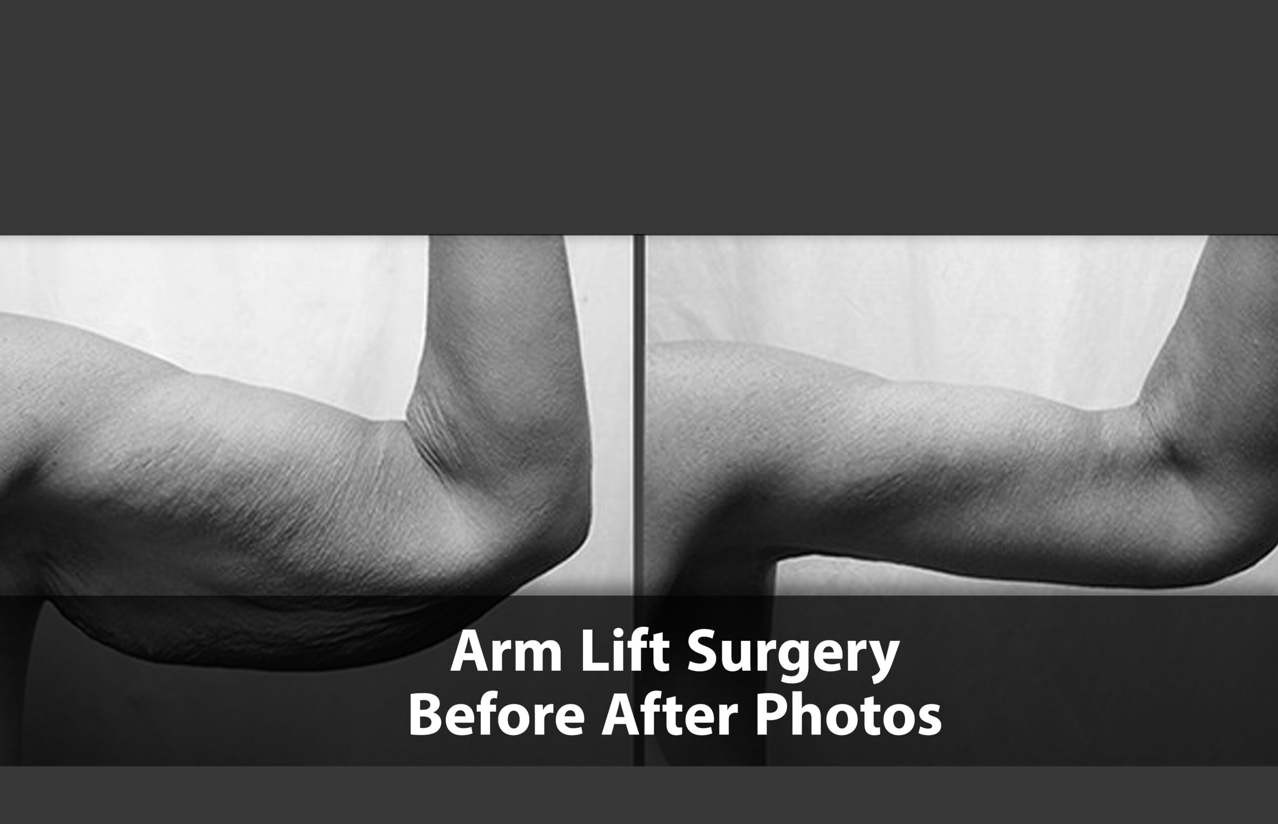 arm lift before after