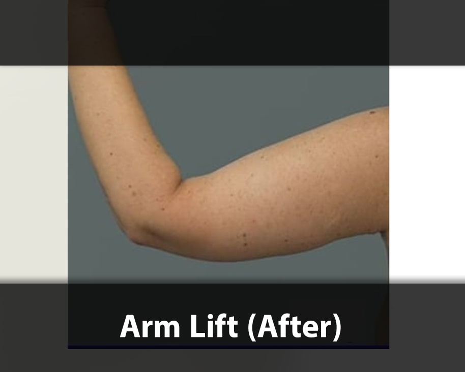 arm lift surgery after