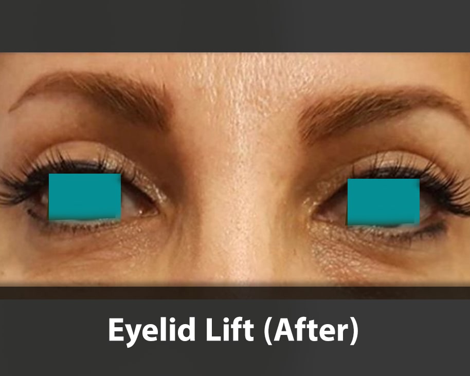 eyelid lift after