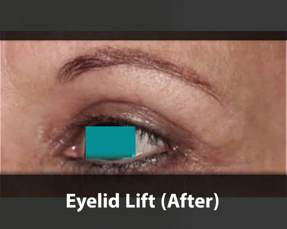 eyelid-after