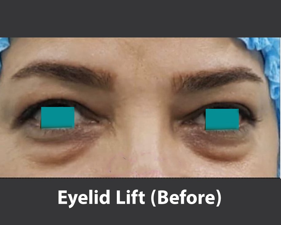 eyelid lift before