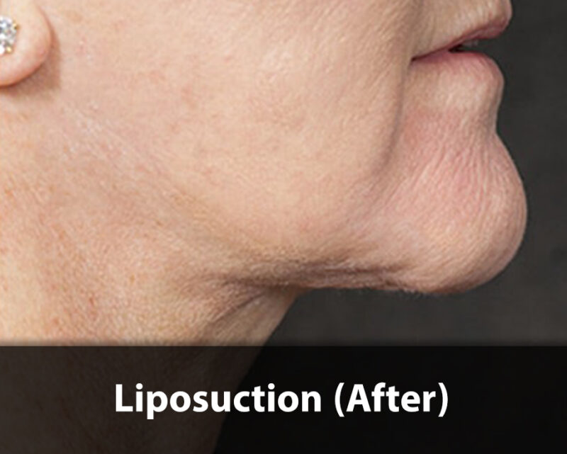 neck liposuction after