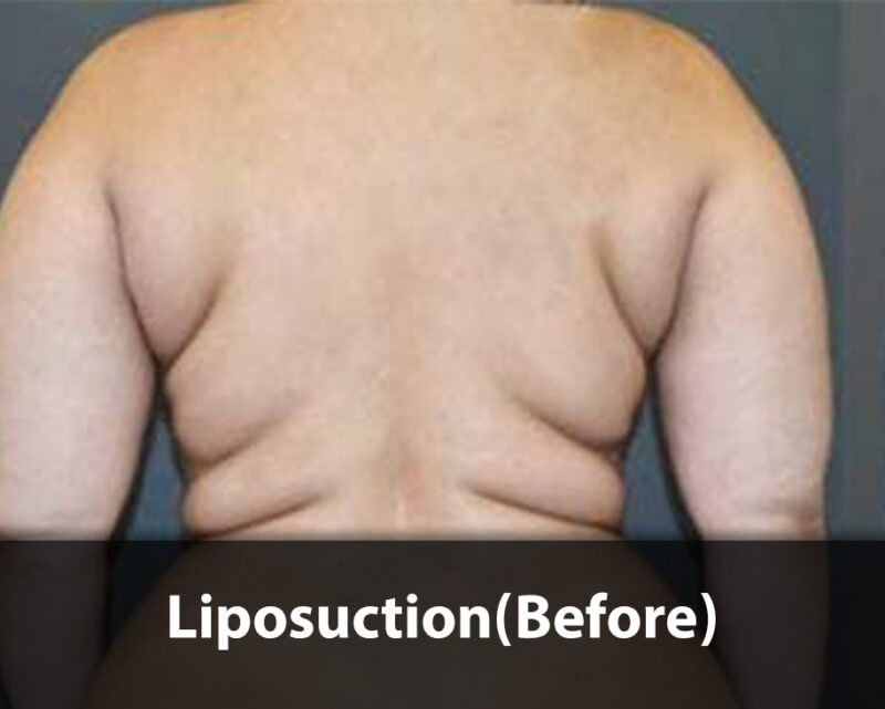 liposuction- before
