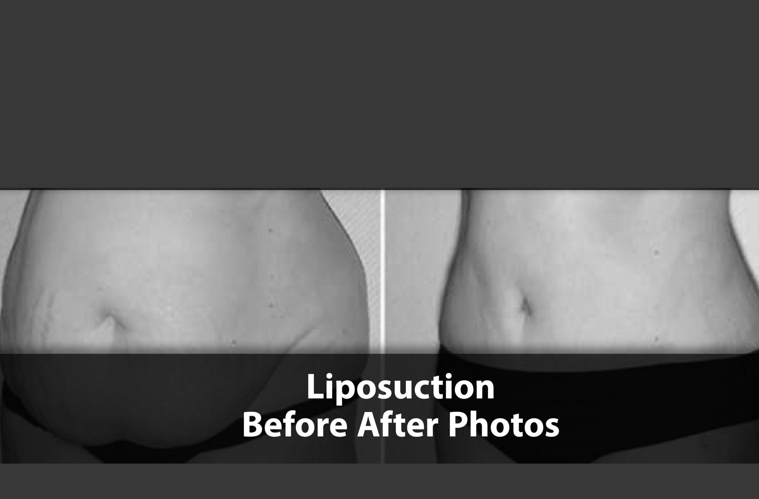 Liposuction before after