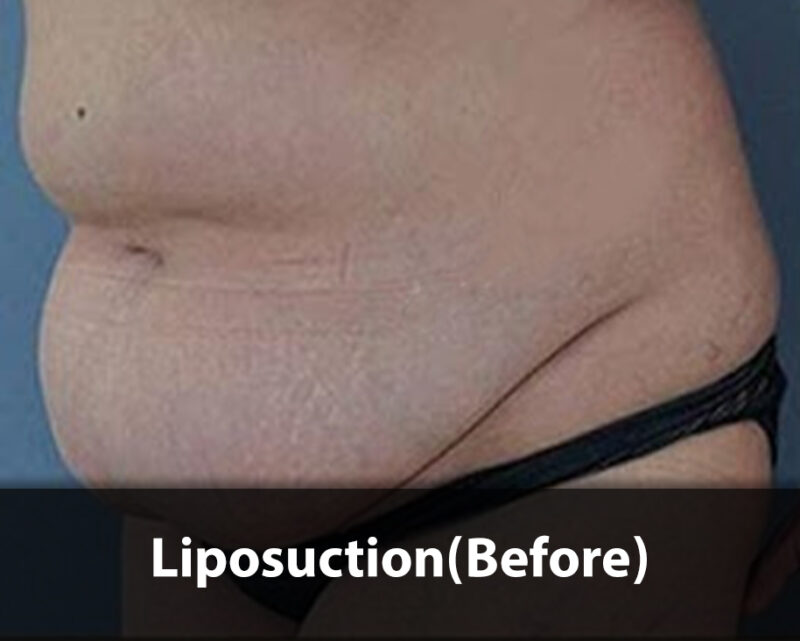 liposuction before