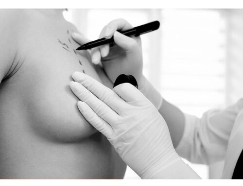 Breast Lift Cost in Toronto, Ontario 2023