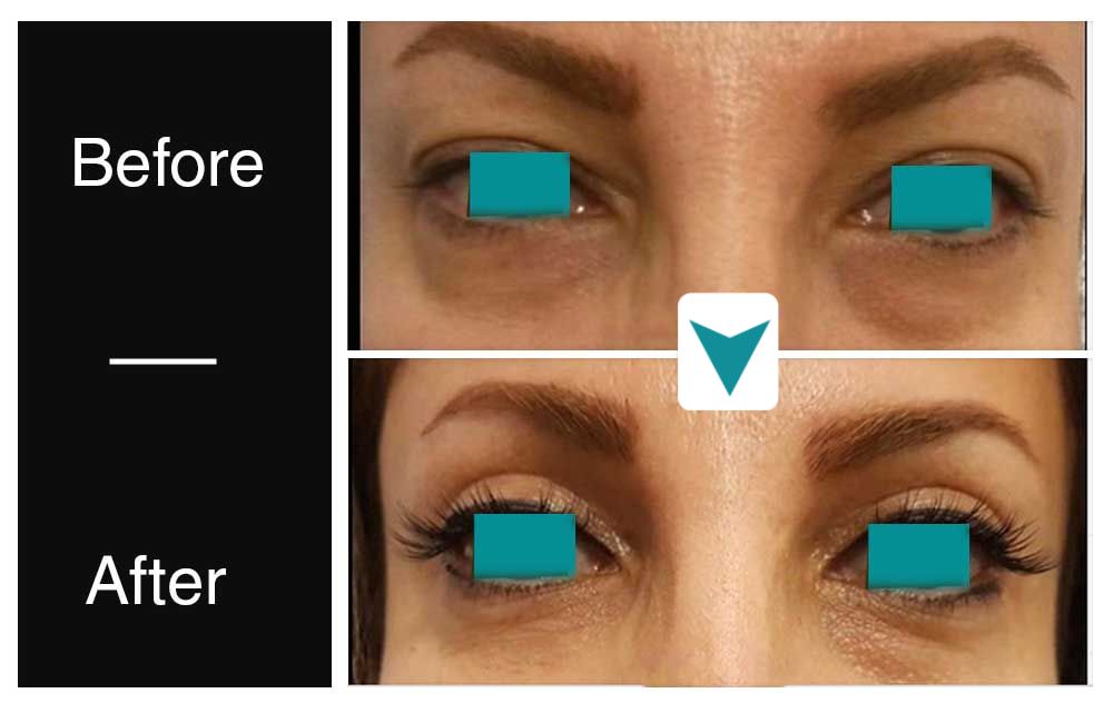 eyelid lift before after