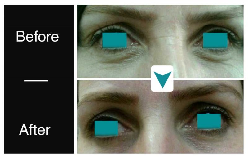 eyelid lift before after