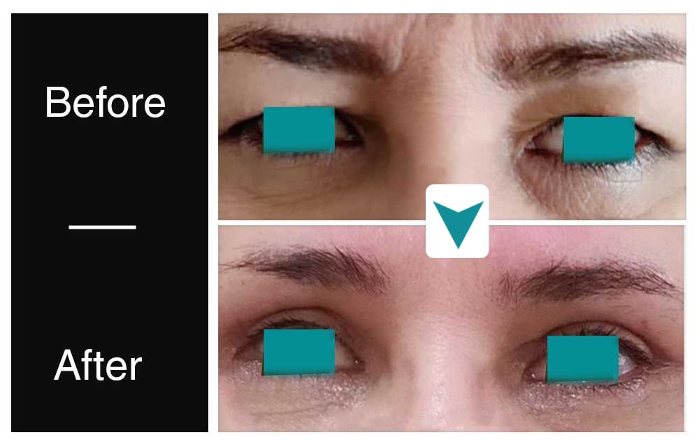 eyelid lift before after