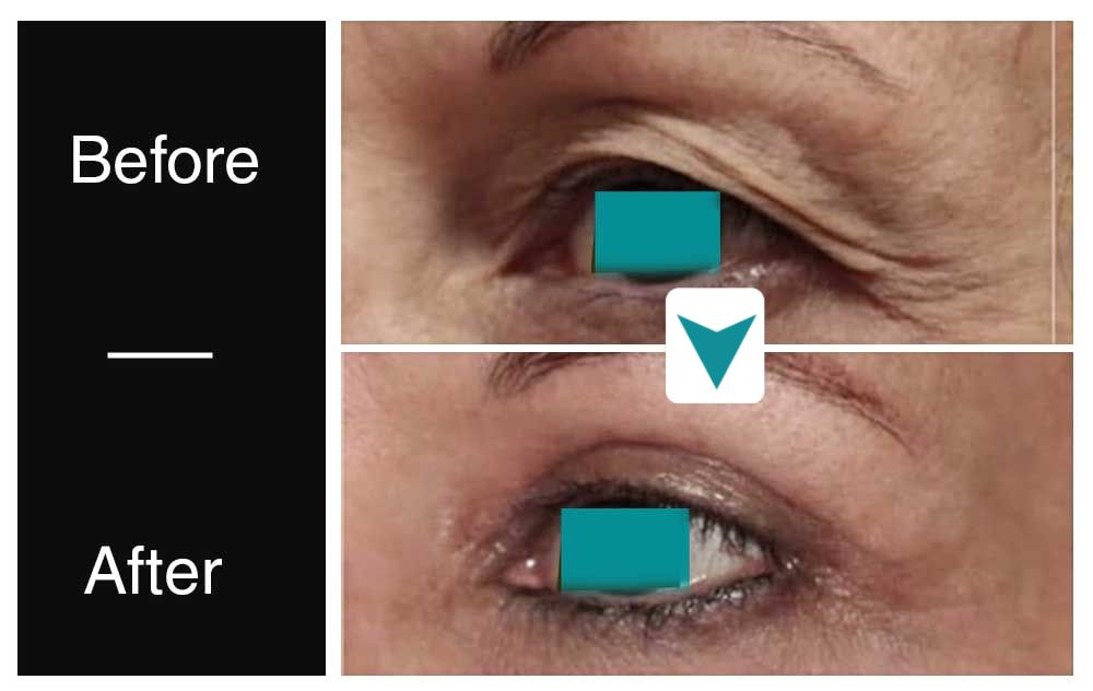 Blepharoplasty before after