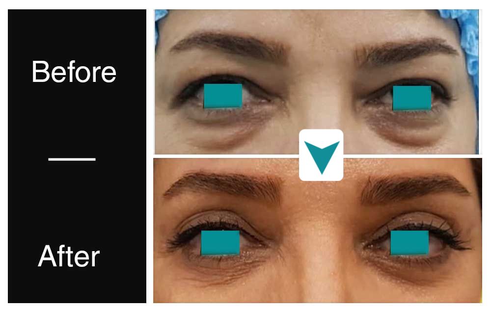 Blepharoplasty before after