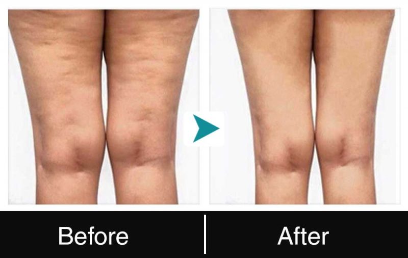 thigh lift before after