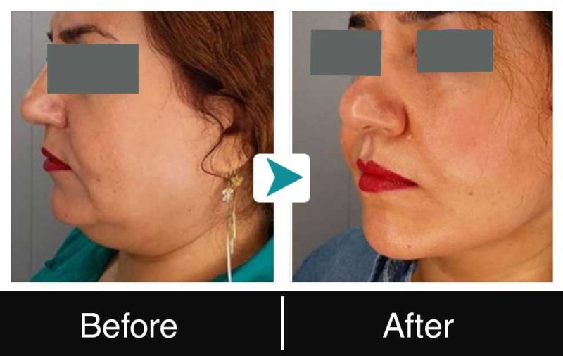 neck liposuction before after