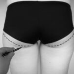 Brazilian-buttock-Lift