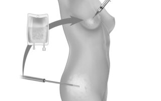 fat grafting vs breast implant