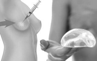 fat grafting vs breast implant