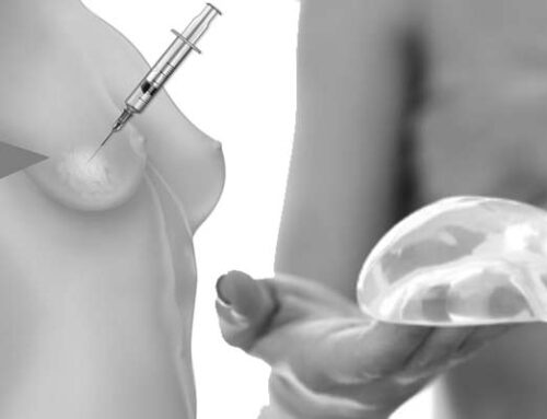 Fat Grafting vs. Breast Implants for Breast Augmentation