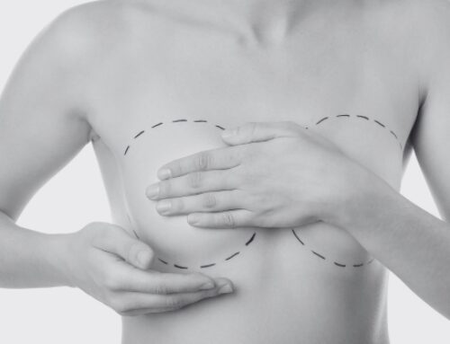 Tips to Reduce Swelling After Breast Augmentation