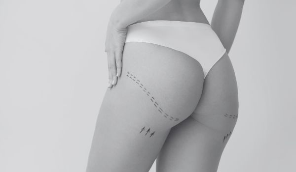Is plastic surgery permanent