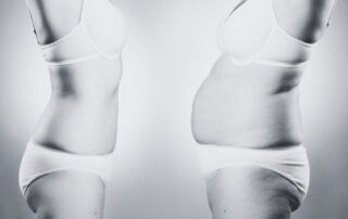 Is liposuction a good way to lose weight?