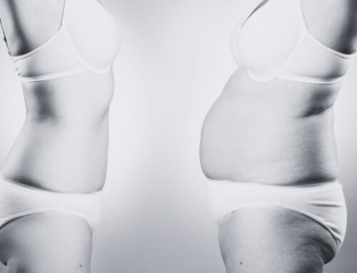 Is liposuction a good way to lose weight?