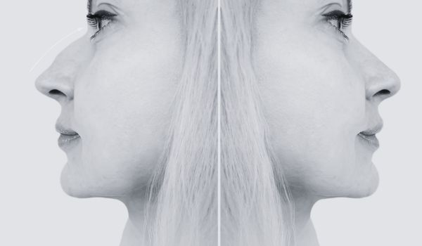 When is the best time to get a nose job? 