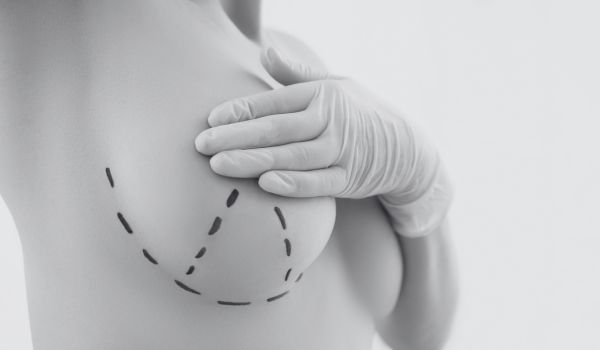 breast lift recovery week by week 