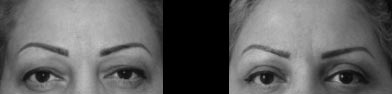 What surgery makes your eyes look younger?