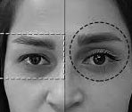 Will I look younger after eyelid surgery