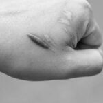 How do you fade scars fast?