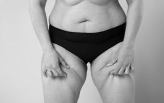 liposuction for big legs