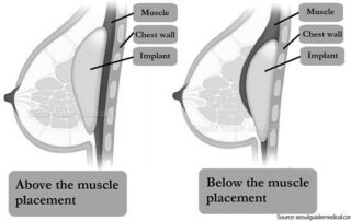 breast augmentation placement