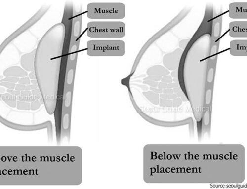 Breast Augmentation: Under the Muscle vs. Over the Muscle
