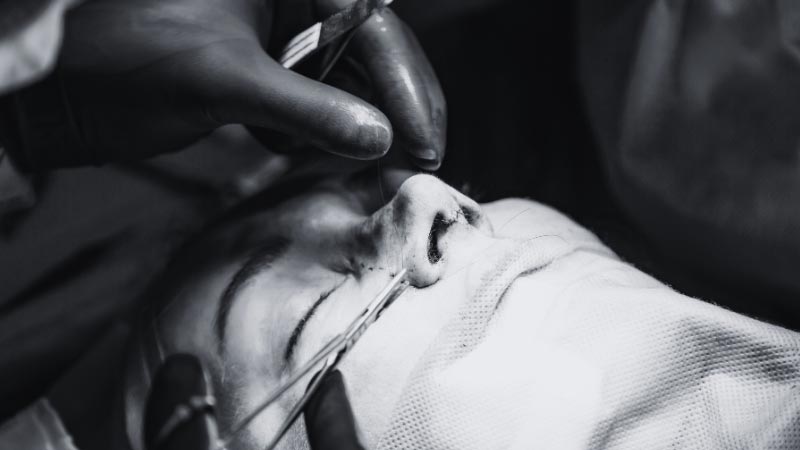 rhinoplasty