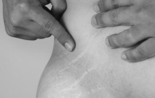 can a tummy tuck get rid of stretch marks