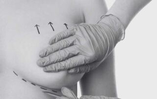 Breast Lift Surgeon