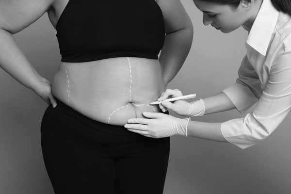 How to Prepare for Liposuction