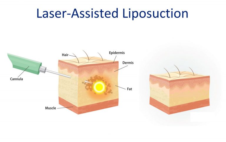 how many types of liposuction are there