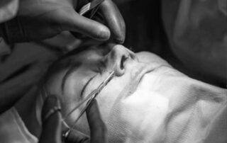 Rhinoplasty Stitches